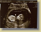 Week12-Ultrasound-01Aug2011 (2) * 3096 x 2387 * (1.79MB)